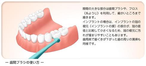 歯間ブラシ
