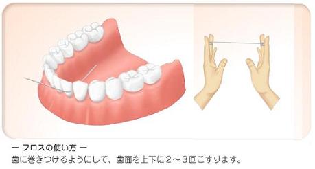 インプラント後の手入れの仕方
