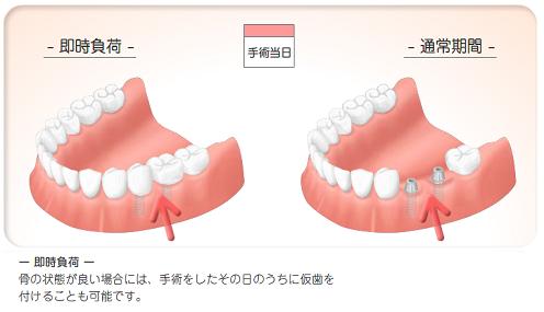 患者さんにやさしいインプラント