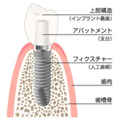 インプラントのとは1