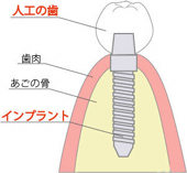 インプラントのとは3