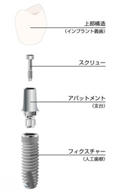 インプラントの構造1